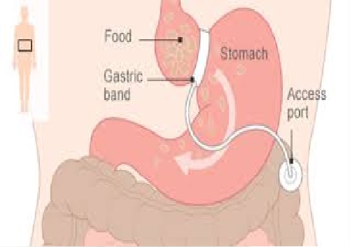 weight loss surgery